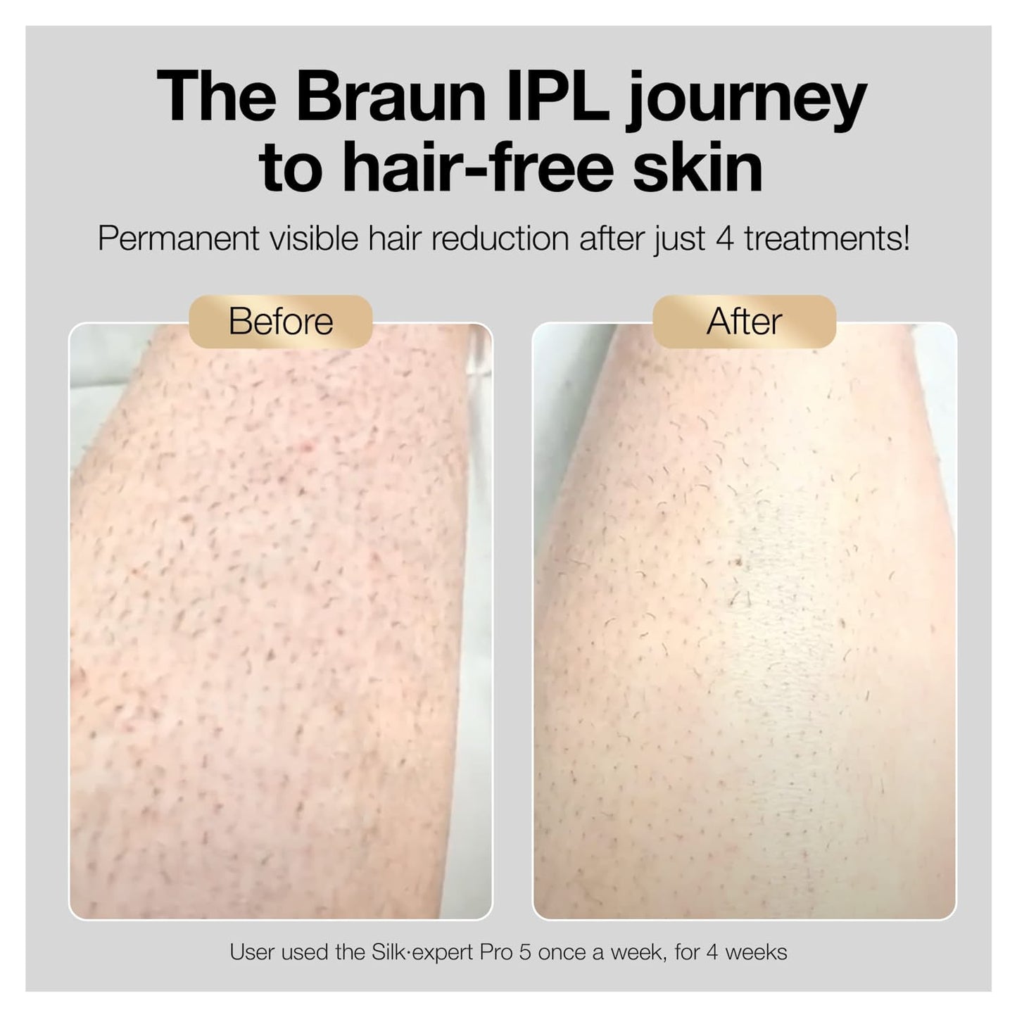 Braun IPL Hair Removal for Women and Men, New Silk Expert Pro 5 PL5157 FDA Cleared, for Body & Face, At-Home Permanent Hair Reduction, Alternative to Salon Laser Hair Removal, with Venus Razor, Pouch